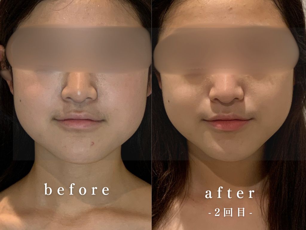 眠れる小顔スパ ビフォーアフター