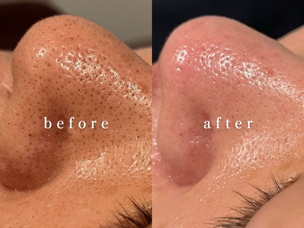 ピュリアス ビフォーアフター